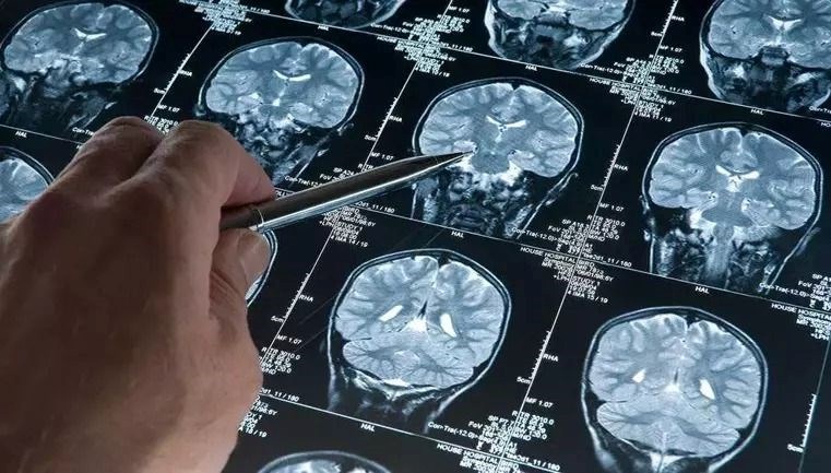 Bilim dünyası şokta: En genç Alzheimer olayı teşhis edildi