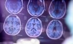 alzheimer-olumcul-hastalik-olmaktan-cikiyor-BGSNKrsf.jpg