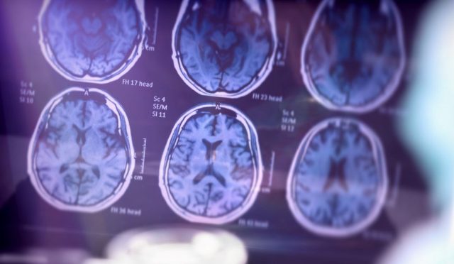 alzheimer-olumcul-hastalik-olmaktan-cikiyor-BGSNKrsf.jpg