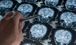 alzheimer-tedavisinde-lityum-takviyesi-umudu-hWeAfbX1.jpg