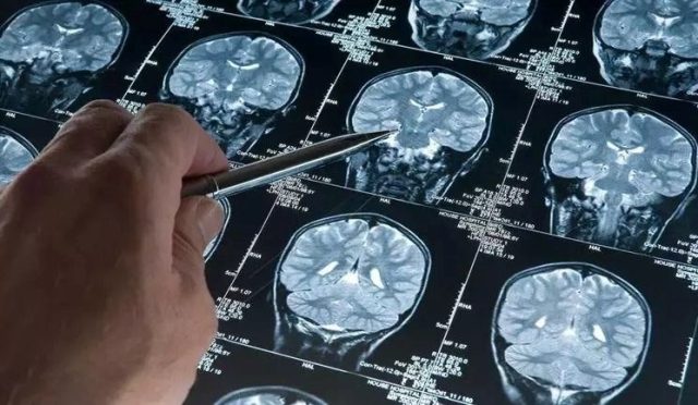 alzheimer-tedavisinde-lityum-takviyesi-umudu-hWeAfbX1.jpg