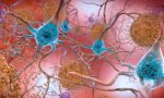 alzheimer-tedavisinde-yeni-umut-2-kanser-ilaci-deva-olabilir-zDkzNwZw.jpg