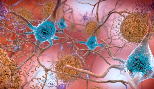 alzheimer-tedavisinde-yeni-umut-2-kanser-ilaci-deva-olabilir-zDkzNwZw.jpg