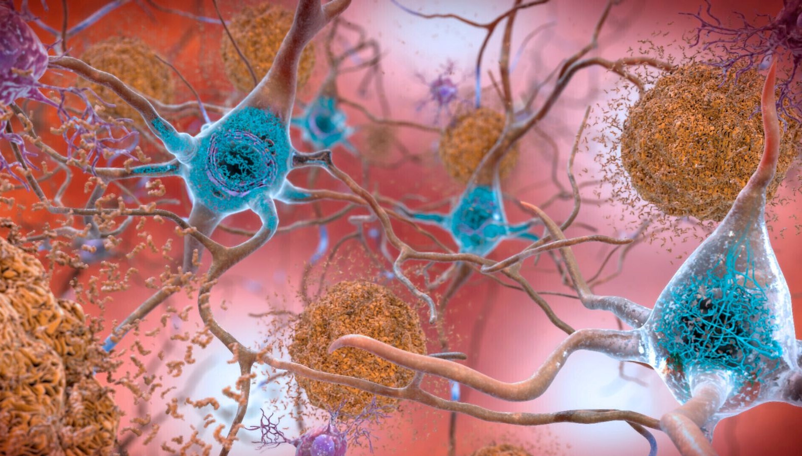 Alzheimer tedavisinde yeni umut: 2 kanser ilacı deva olabilir