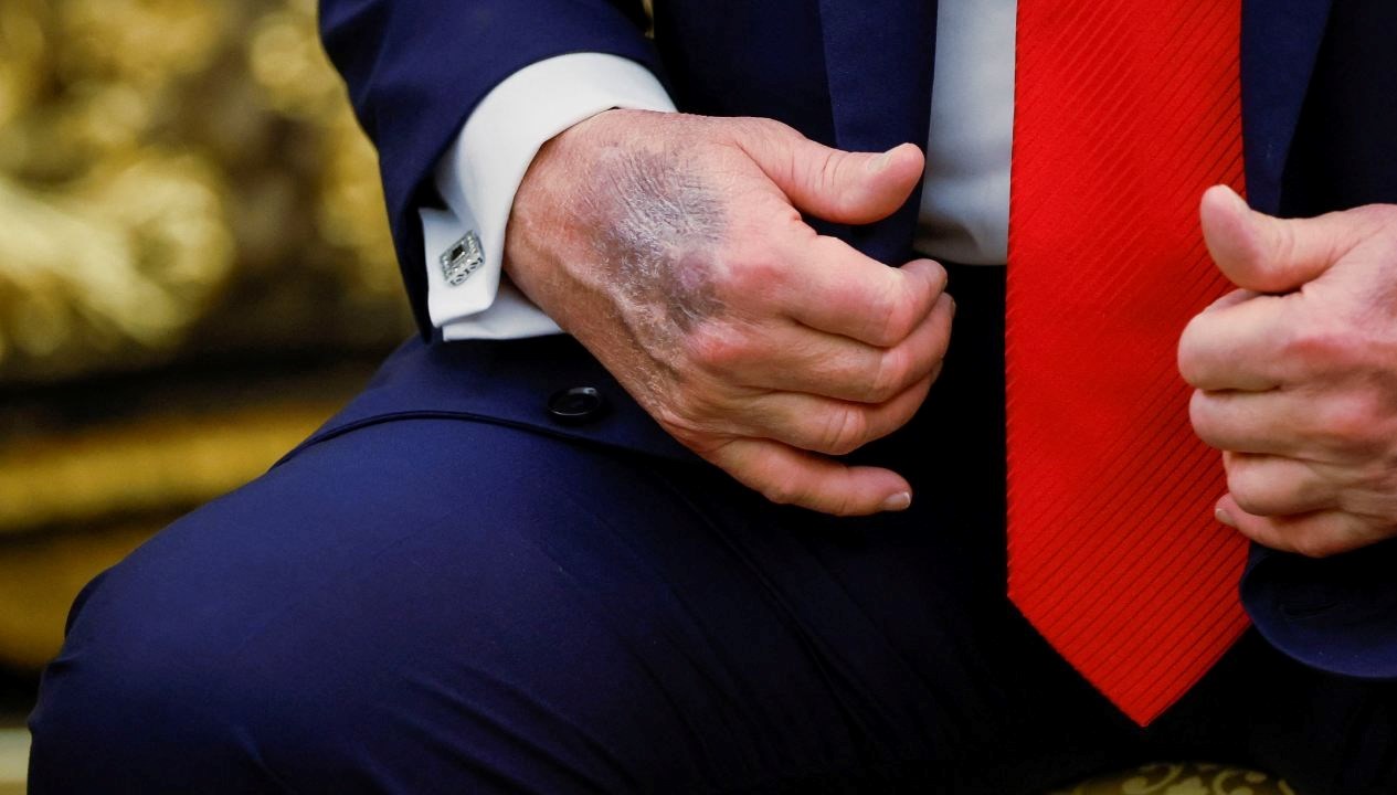 Trump’ın eli yeniden gündem oldu, Beyaz Saray’dan açıklama geldi